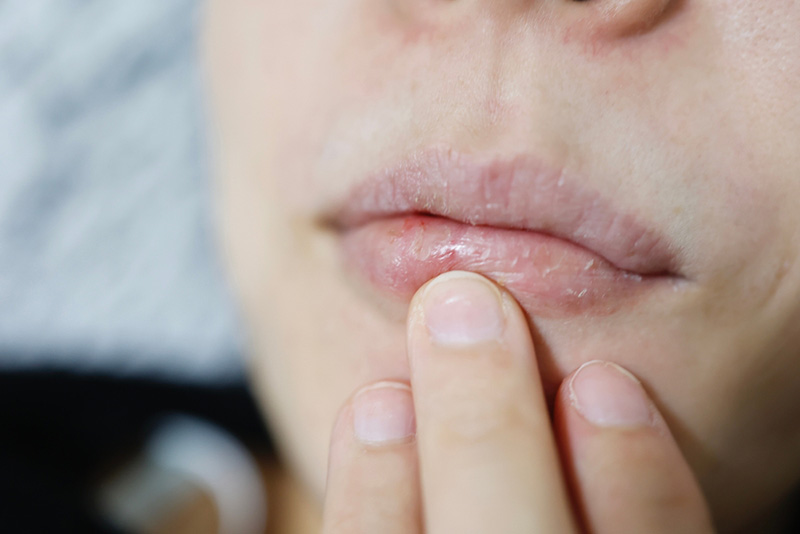 ปากแห้งลอก