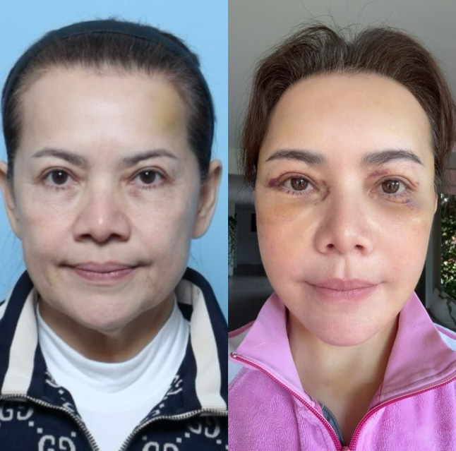 ส่องภาพก่อน-หลังศัลยกรรม หนูแหม่ม สุริวิภา ในวัย 58 สวยเป๊ะย้อนวัยสุด ๆ