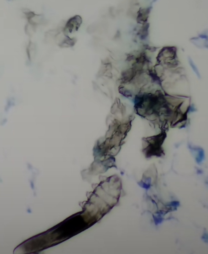 ตรวจเชื้อสิว