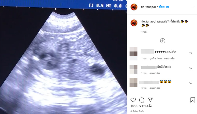 เติ้ล ธนพล อวดคลิปอัลตราซาวด์