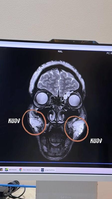 นัท นิสามณี หน้าบวมจนจำไม่ได้