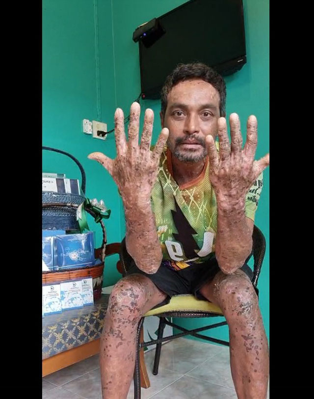 เมฆ วินัย ไกรบุตร โรคตุ่มน้ำพอง