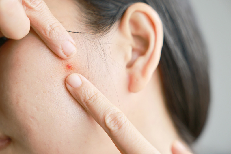 สิวเป็นไต