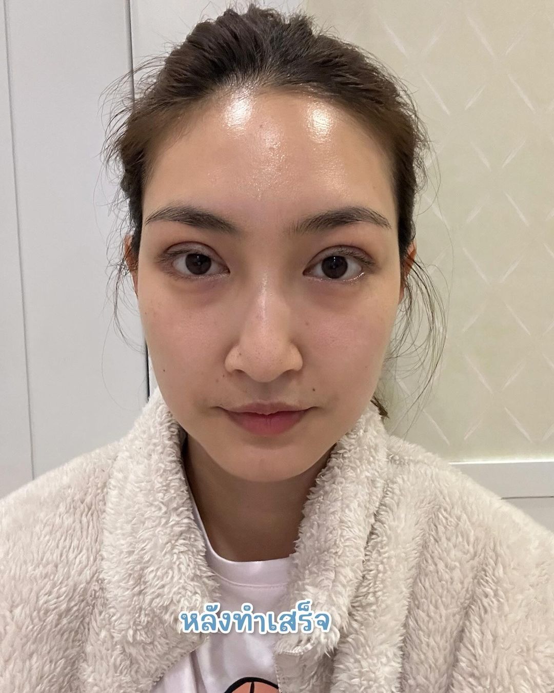 แพนเค้ก เขมนิจ ศัลยกรรม