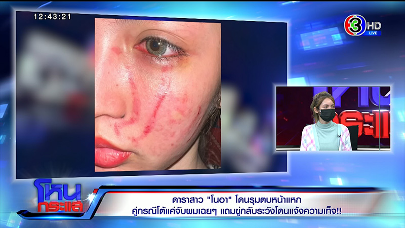 โนอา ภญมน ถูกตบหน้าพังเป็นหนอง