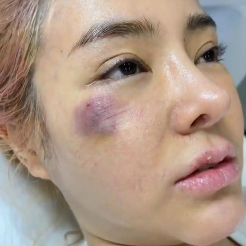 กัสจัง หน้าติดวัณโรคเทียม