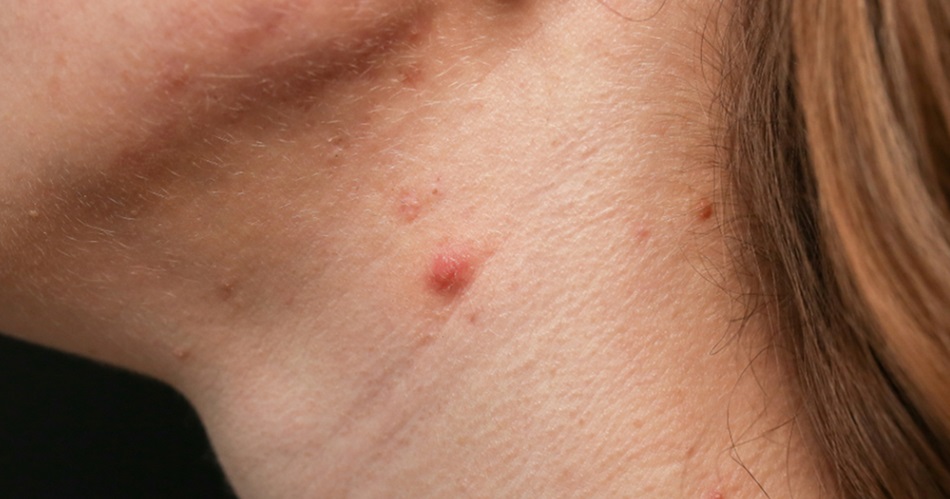 สิวขึ้นคอ