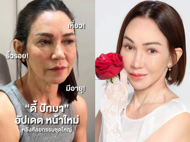 ดี้ ปัทมา ศัลยกรรม