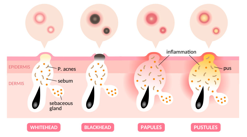 วิธีรักษาสิว