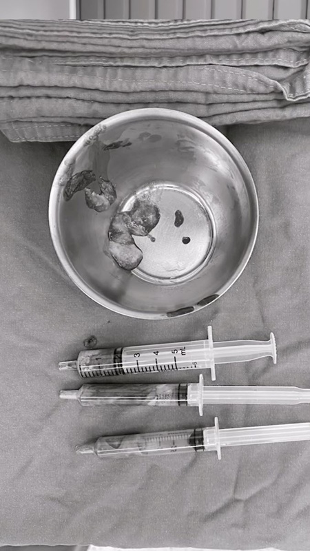 นัท นิสามณี หน้าบวมจนจำไม่ได้