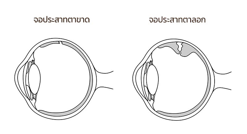 จอประสาทตาขาด เกิดจากอะไร