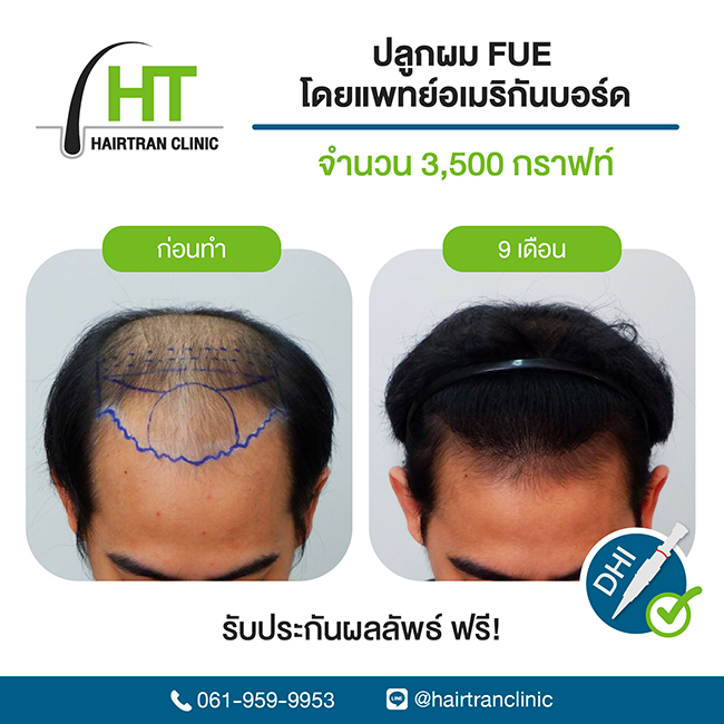 สร้างชื่อ ! หมอแพตตี้ จาก Hairtran Clinic คว้าคะแนนสอบปลูกผมอันดับ 1 ของโลก