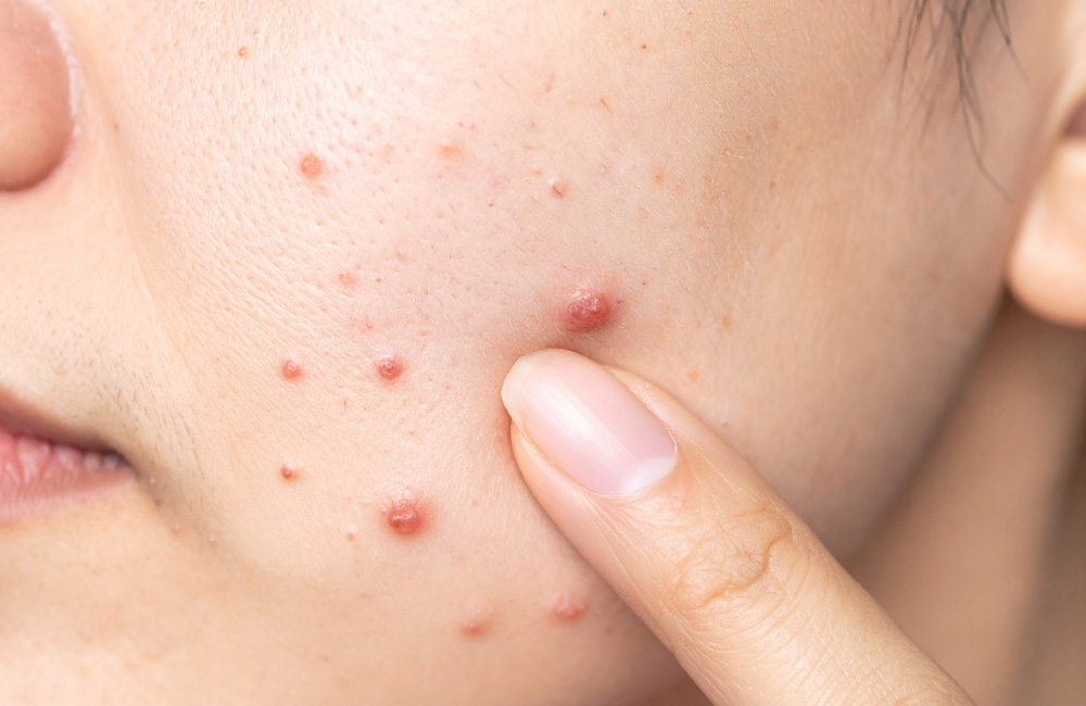 ขั้นตอนการเข้ารับบริการรักษาสิวที่ M Vita Clinic
