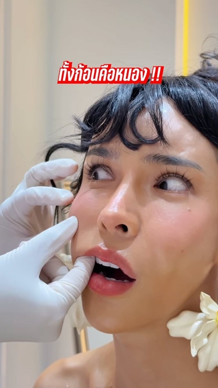 นัท นิสามณี หน้าบวมจนจำไม่ได้