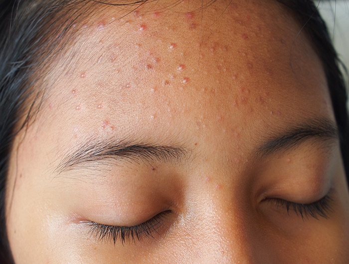 วิธีรักษาสิว