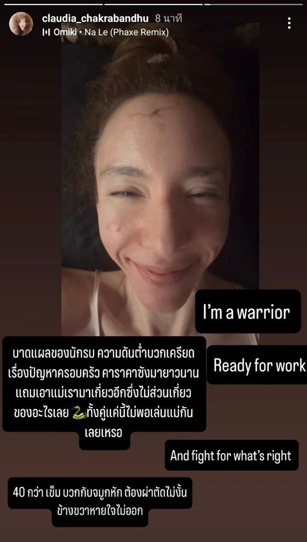 ภาพล่าสุด คลาวเดีย เผยที่มาแผลเย็บ 40 กว่าเข็ม