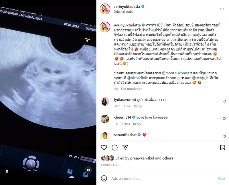 แอริน ยุกตะทัต รีวิวทำ ICSI ผสมตัวอ่อนรอบที่ 2 