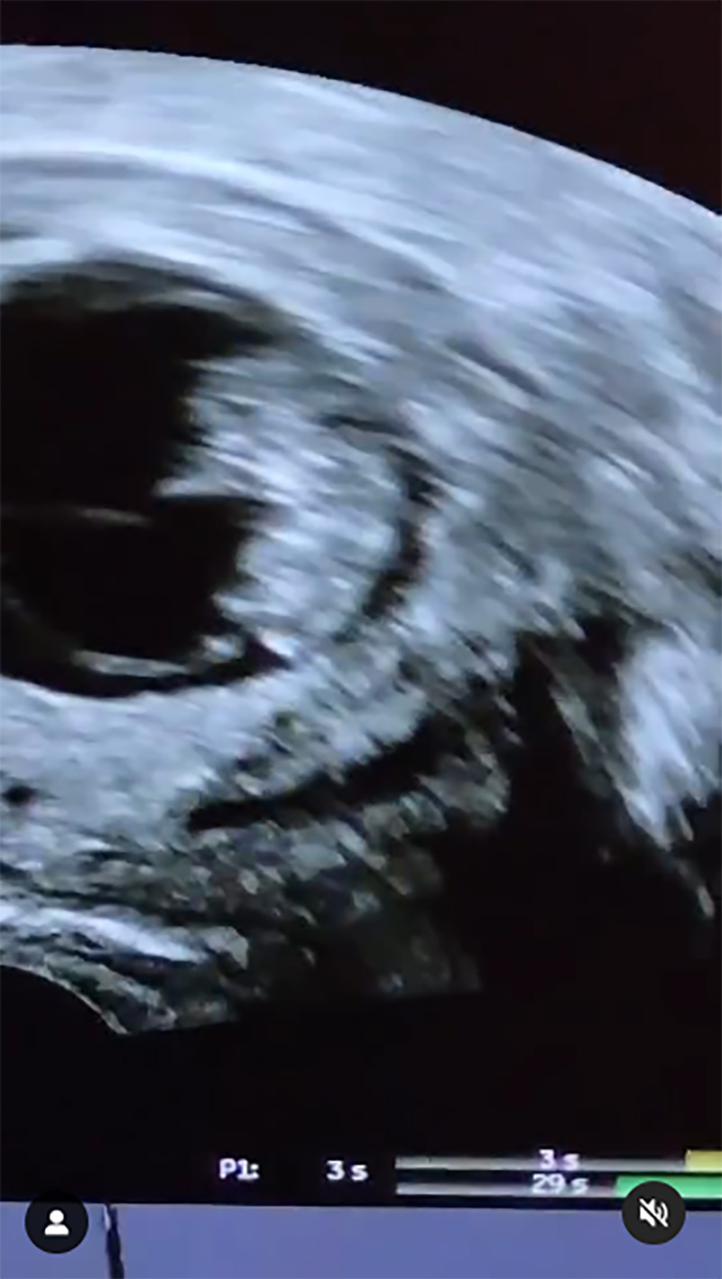 มน Room39 เผยข่าวดีตั้งท้องลูกคนแรกสำเร็จ ในวัย 41 ปี