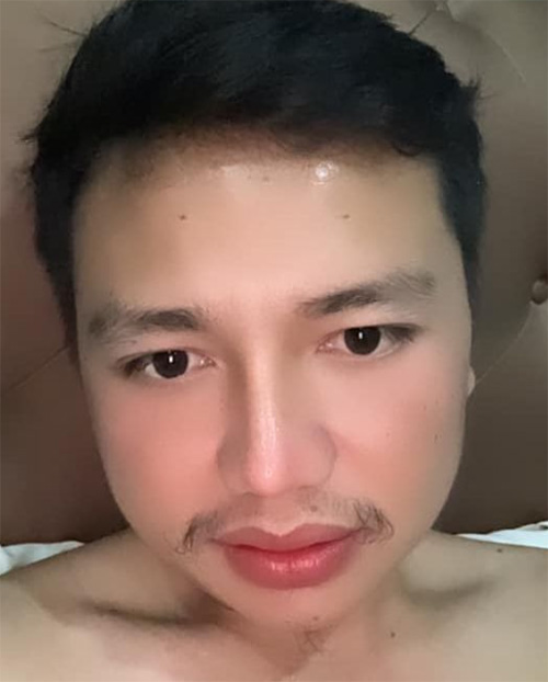 ครูไพบูลย์ แสงเดือน ศัลยกรรม