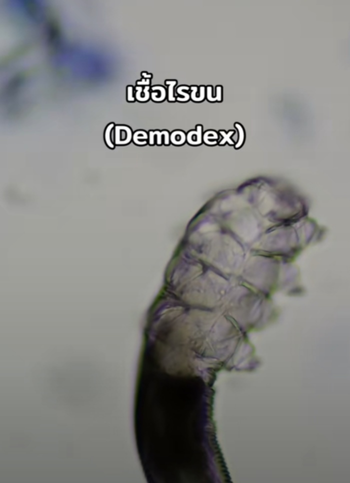 ตรวจเชื้อสิว