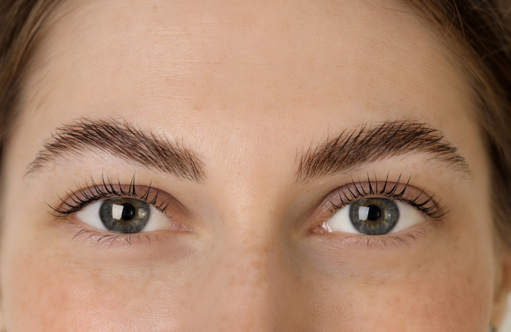 Direct Brow Lift