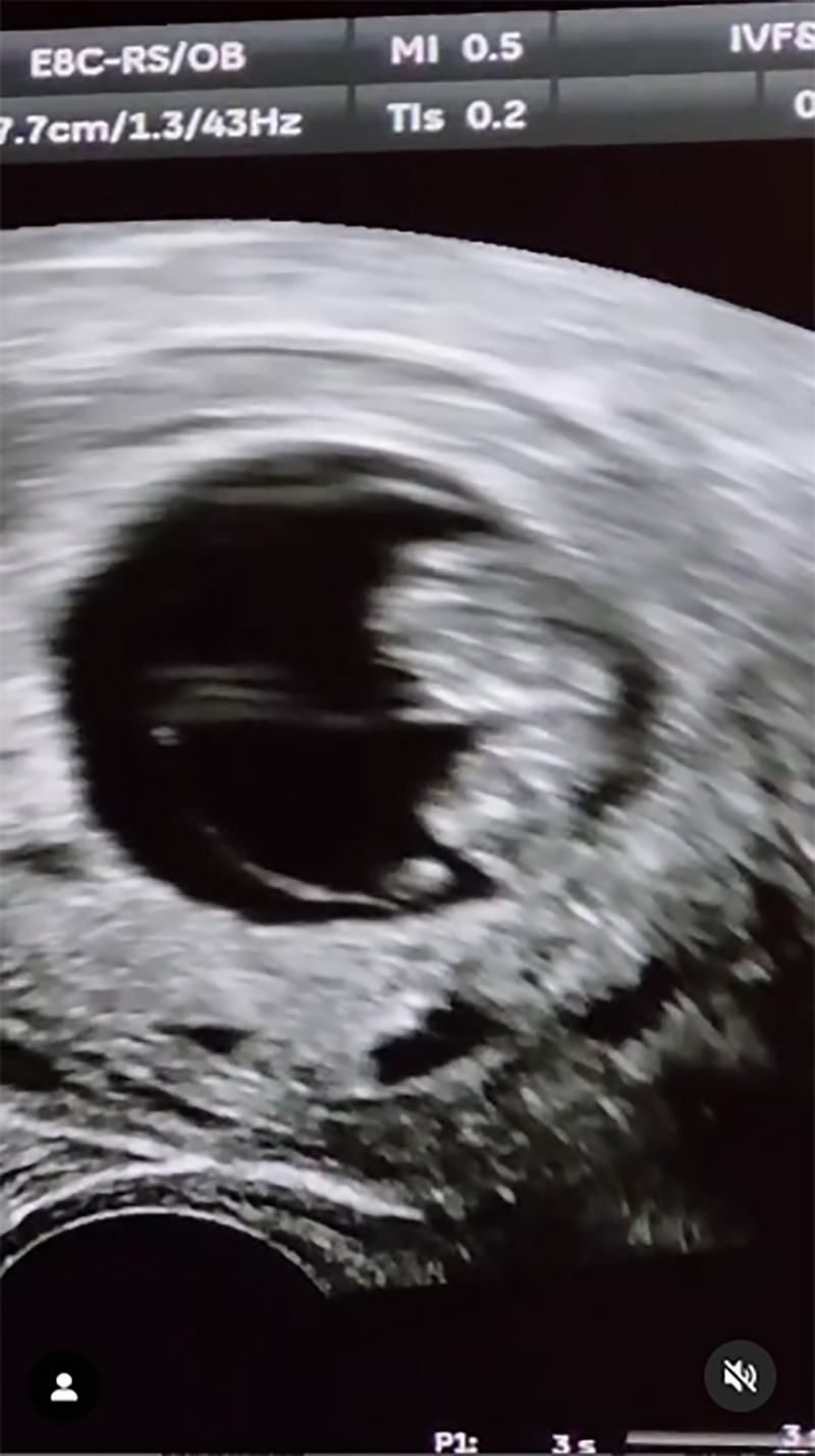 มน Room39 เผยข่าวดีตั้งท้องลูกคนแรกสำเร็จ ในวัย 41 ปี