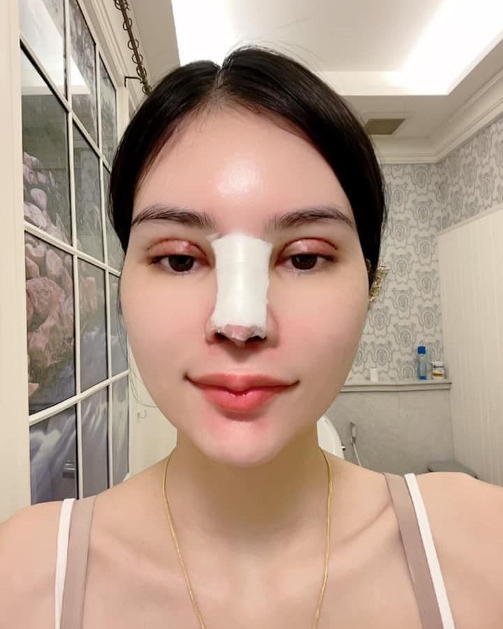 เอ๋ มิรา ศัลยกรรม 