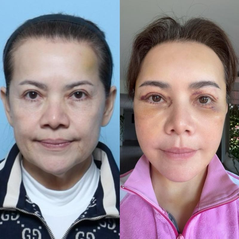 หนูแหม่ม สุริวิภา ศัลยกรรมลดวัย