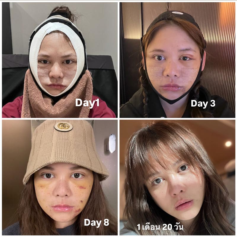 พิมพ์ พิมพ์มาดา ทำศัลยกรรมยกหน้าใหม่